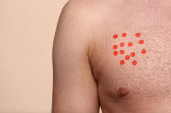 An image of a chest with red stickers dotted around the nipple area | CoppaFeel! | Breast cancer info and advice